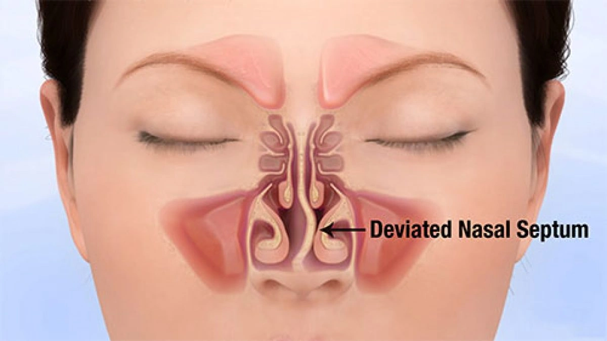 Septum Deviation Nose